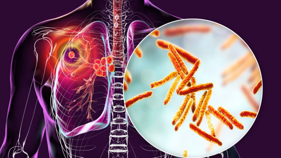 TB patients is constantly increasing